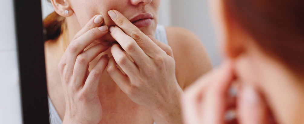 How to Get Rid of Blackheads for Clear Skin?