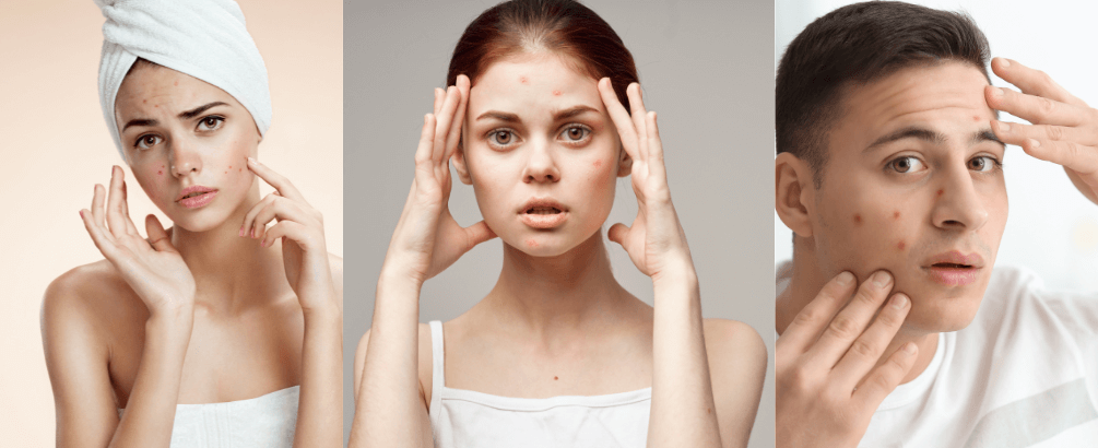 How to Get Rid of Acne Start With Water Quality?