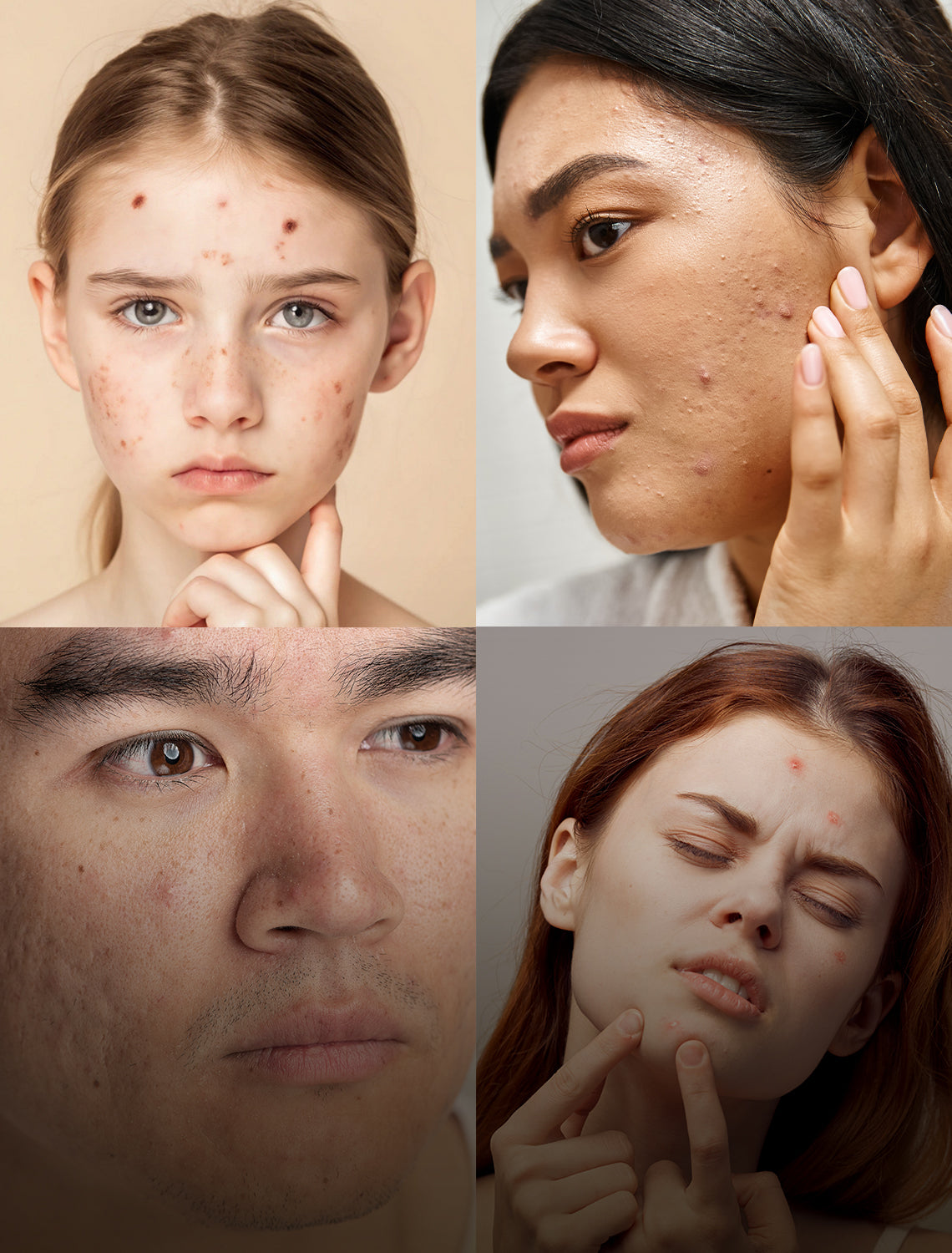 How to Get Rid of Acne Start With Water Quality?